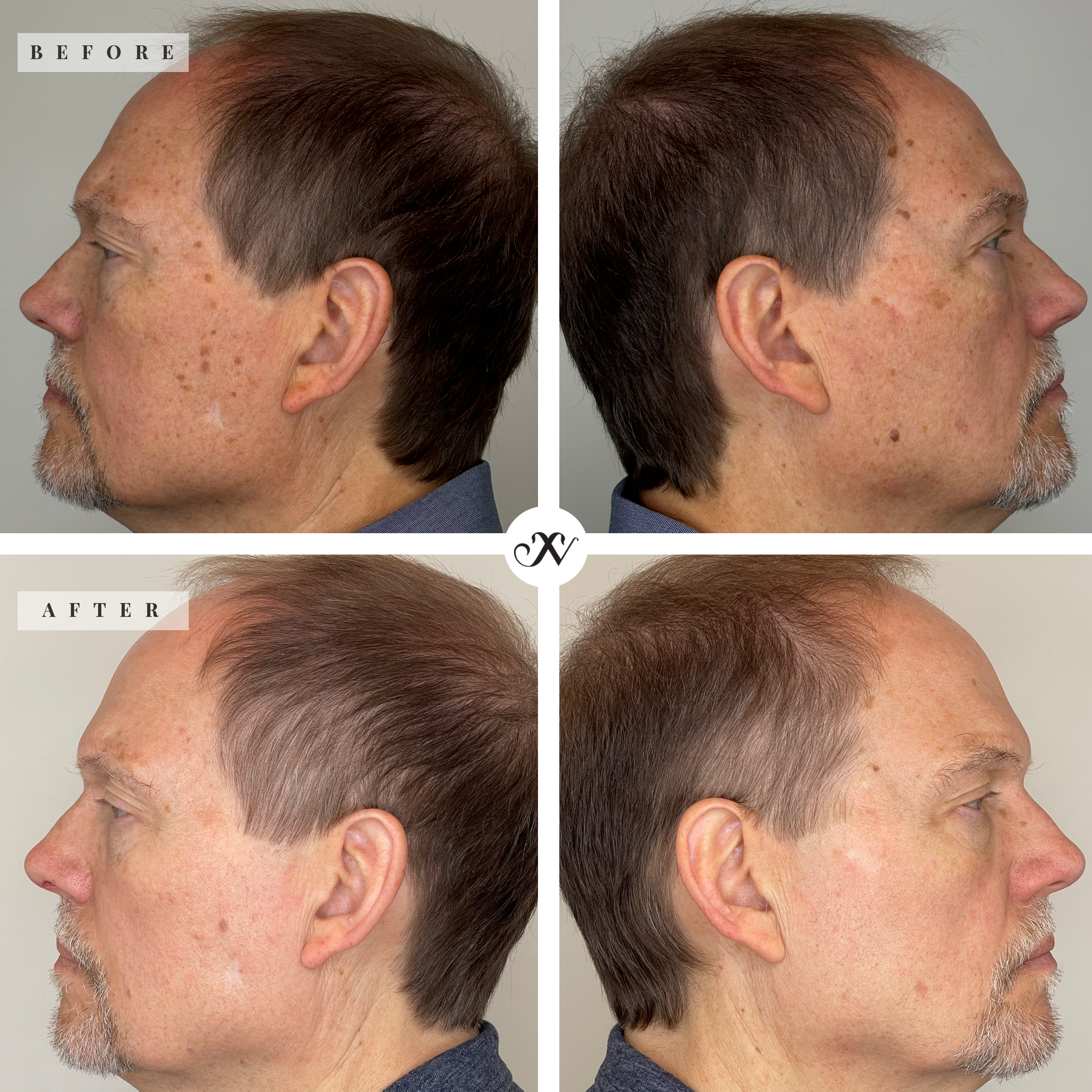 Buy 3 Morpheus8, Get 1 Lumecca FREE - Image 6