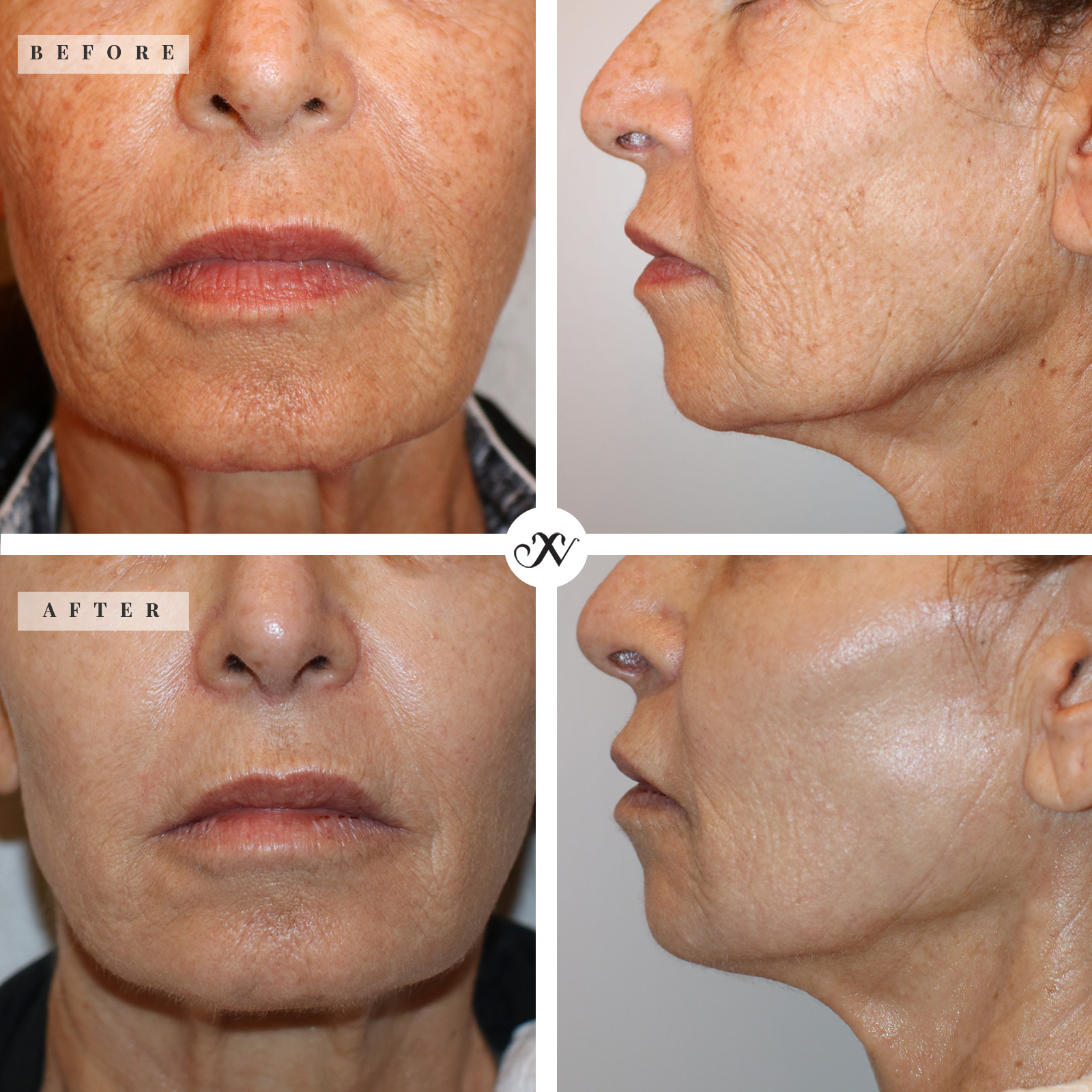 Pro-Fractional Laser Peel - 20% OFF