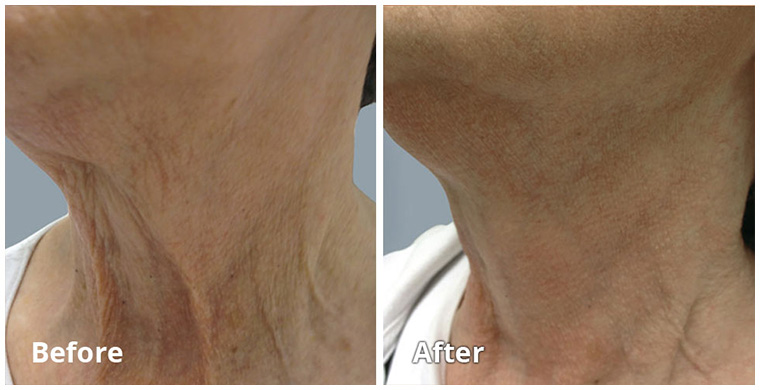 Fractora Skin Tightening - 20% OFF - Image 2