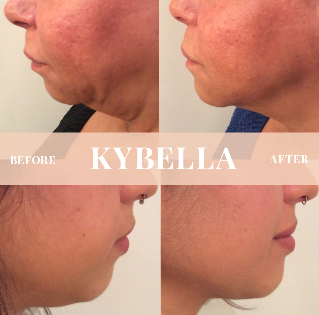 Kybella Package of 3 - 20% Off